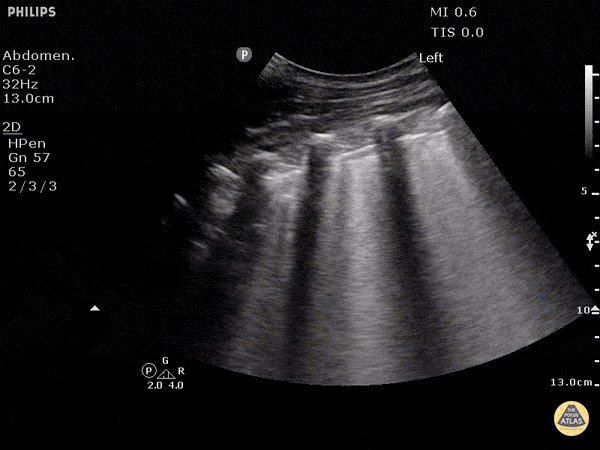 EA Echo Examples - B-Lines - Pulmonary Edema