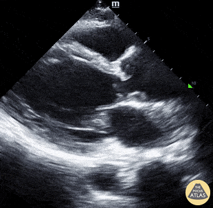Thoracic Aortic Dissection & Aneurysm - Type A Aortic Dissection - Double Valve Sign