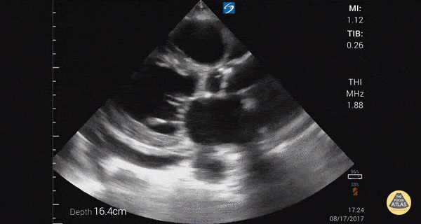 Left Ventricular Dysfunction - Reduced Ejection Fraction (Parasternal Long-Axis View)