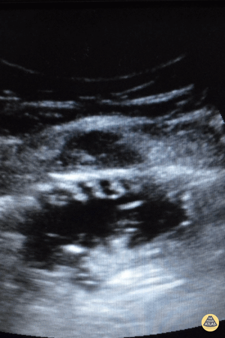 Bowel-GI - The Piano Sign