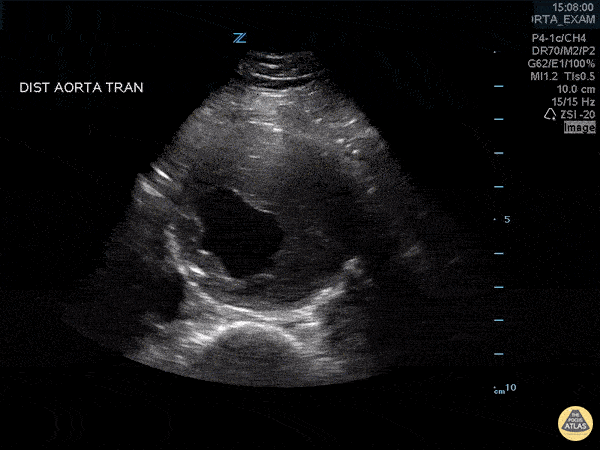 Aorta - Abdominal Aortic Aneurysm with Thrombus