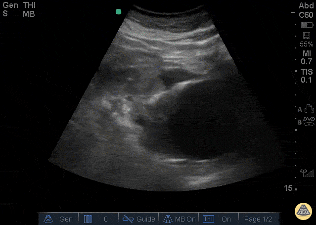 Aorta - Ruptured AAA