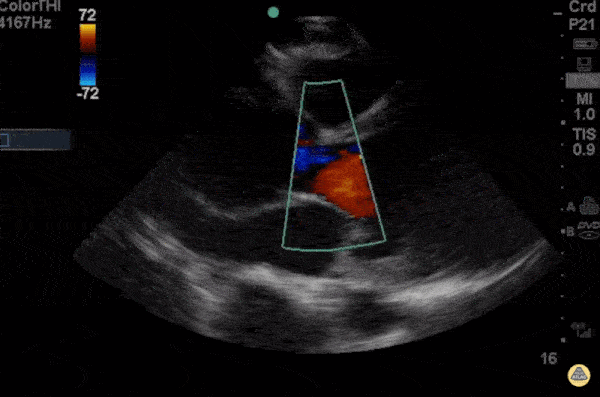 Thoracic Aortic Dissection & Aneurysm - Breaking the rule of 3rds - Aortic Dissection with Root Dilation