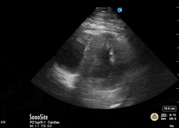Right Ventricular Dysfunction - The D Sign