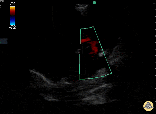Valvulopathy - Moderate Mitral Regurgitation