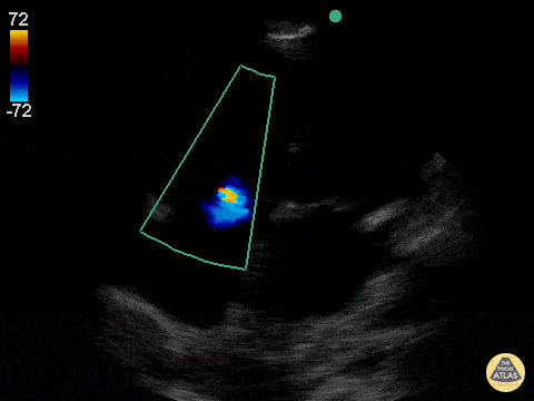 Valvulopathy - Mild Tricuspid Regurgitation
