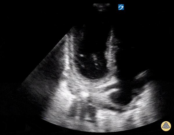 Left Ventricular Dysfunction - Apical Ballooning