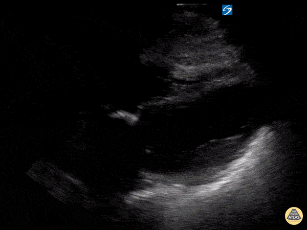 Left Ventricular Dysfunction - Apical Ballooning 2