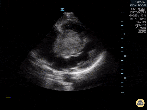 Cardiac Tumors - Atrial Myxoma