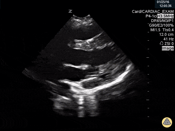 Thoracic Aortic Dissection & Aneurysm - Aortic Dissection Flap Visualized in Proximal Aorta with Root Dilation