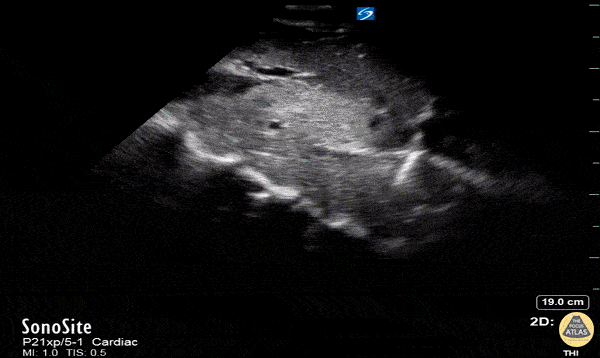 IVC & Abnormal Venous Waveforms - IVC Thrombus