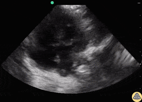 Other Cardiac Pathology - AV Canal Defect