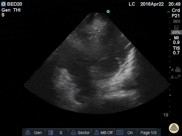 Other Cardiac Pathology - The Saline Flush/Bubble Test