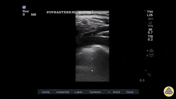 Thoracic Aortic Dissection & Aneurysm - Type B Thoracic Aortic Dissection Flap on Suprasternal View