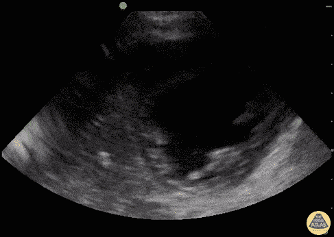Pediatrics - Myocarditis (Infant)