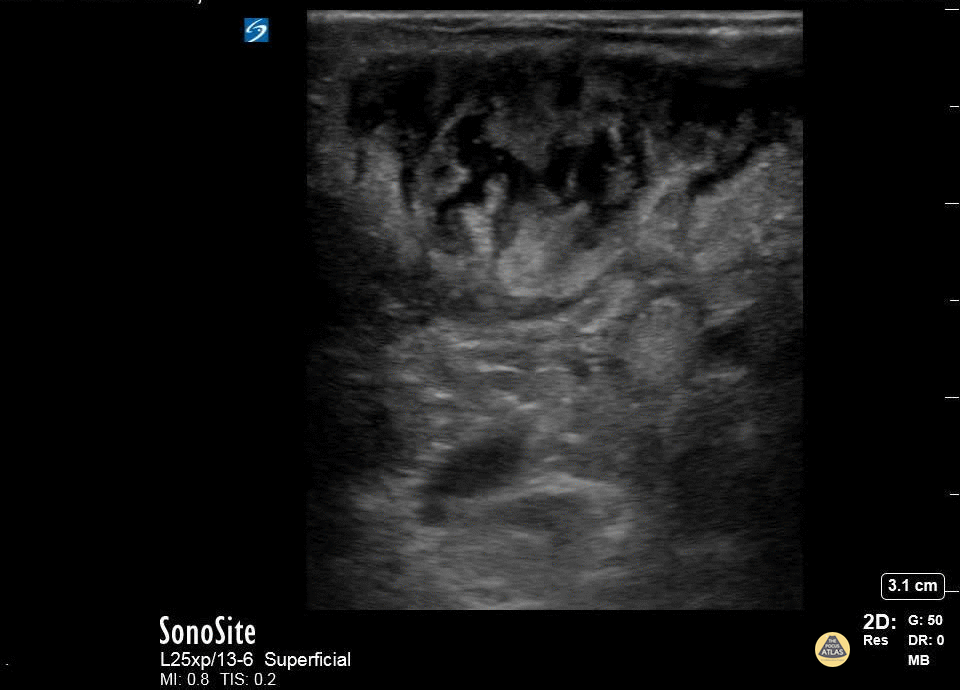 Soft Tissue - Abscess Identification