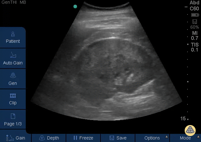 Renal/GU - Perinephric Hematoma