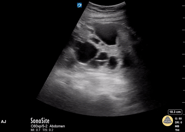 Renal/GU - Polycystic Kidney Disease