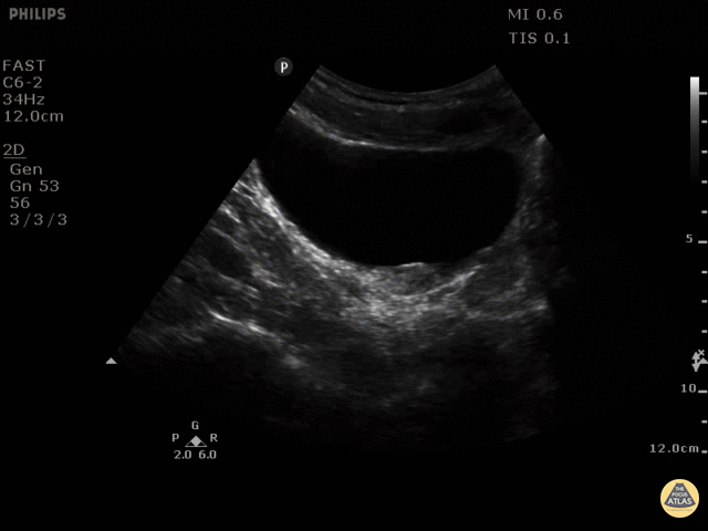 Renal/GU - Ureterovesical Junction Nephrolithiasis