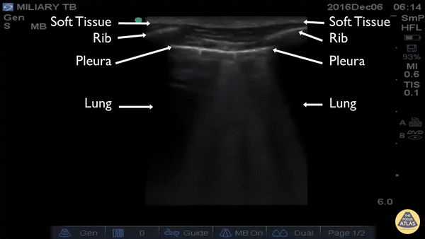 Pulmonary - Miliary TB