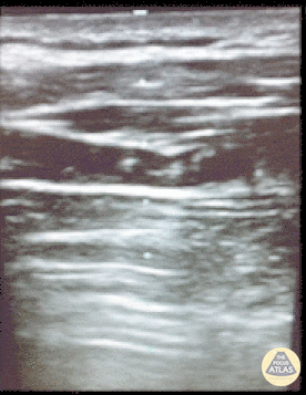 Pulmonary - Resolving Pneumothorax