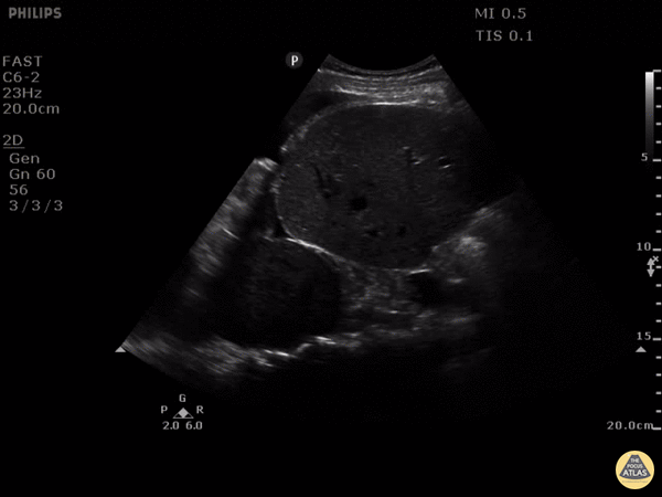 Pulmonary - Pleural Effusion, Mass
