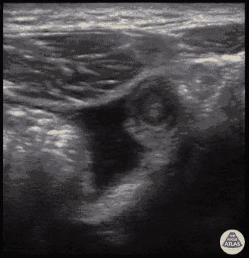 Bowel-GI - Appendicitis + Free Fluid