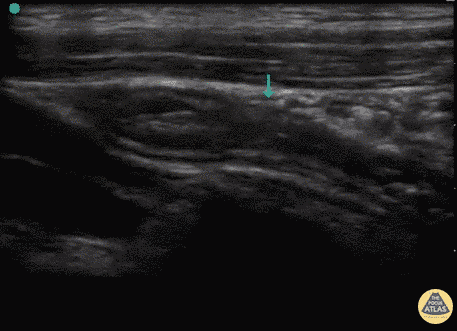 Bowel-GI - Normal Appendix (Longitudinal)