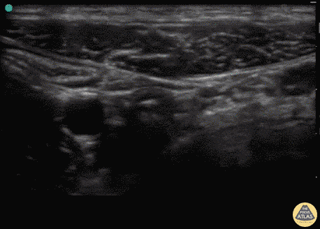 Bowel-GI - Normal Appendix (Transverse)