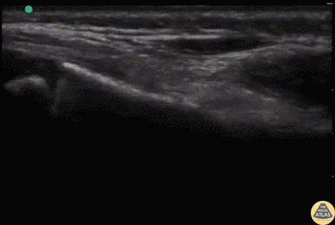Pediatrics - Radius Fracture (Distal)