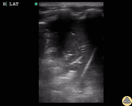 Pediatrics - Lung Hepatization (Pneumonia)