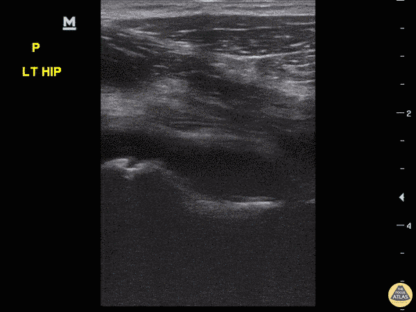 Pediatrics - Hip Effusion