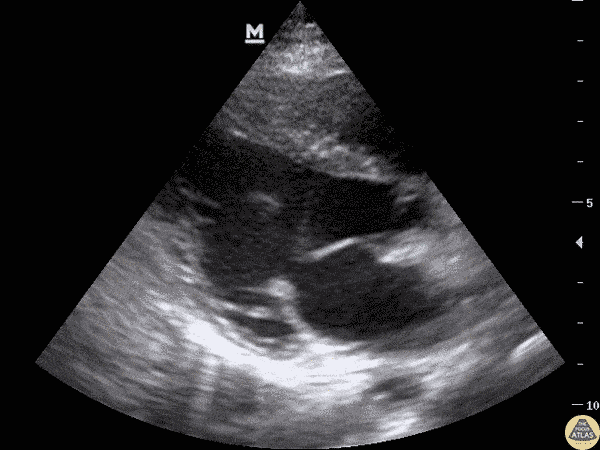 Pediatrics - HOCM Hypertrophic Cardiomyopathy