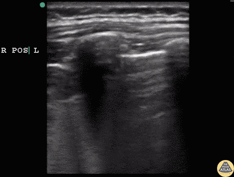 Pediatrics - Hydrocarbon Ingestion with C-Lines
