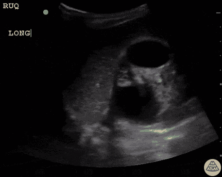 Renal/GU - Severe Hydronephrosis in Prune Belly Syndrome