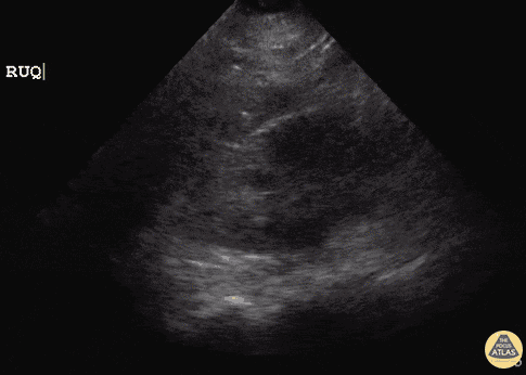Pediatrics - Hydronephrosis (Mild)
