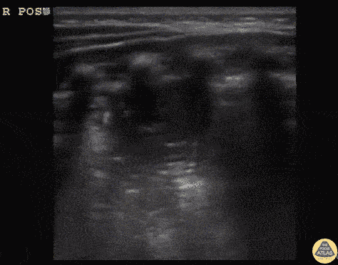 Pediatrics - Infant Pneumonia with C-Lines