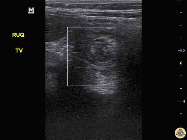 Peds-Gastrointestinal - Intussusception with Target Sign
