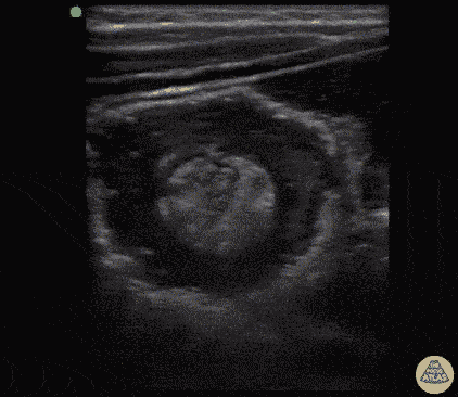 Peds-Gastrointestinal - Intussusception with Target Sign