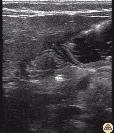 Peds-Gastrointestinal - Pylorus (Normal)