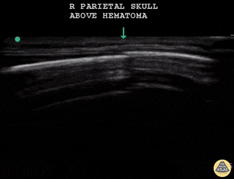 Pediatrics - Infant Skull Fracture