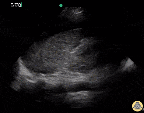 OB/Gyn - Uterine Rupture (Positive FAST)