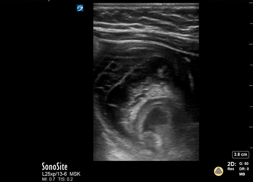 Peds-Gastrointestinal - Intussusception - Colicky Abdominal Pain