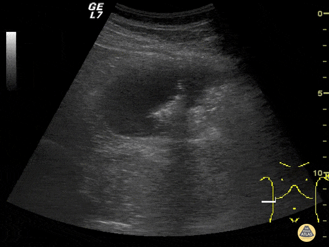 Bowel-GI - Biliary Colic That Wasn't