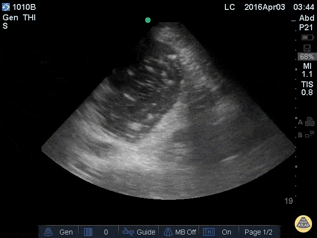 Bowel-GI - Reducing Aspiration Risk