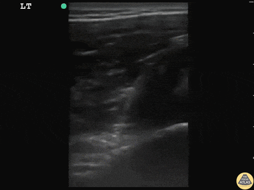 Pediatrics - Shoulder Dislocation and Reduction