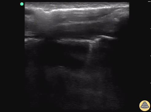 Pediatrics - Pneumothorax with Lung Point