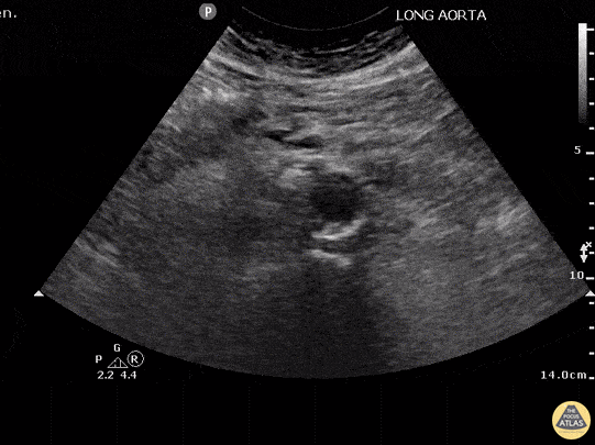 Aorta - Abdominal Aortic Dissection (Transverse)