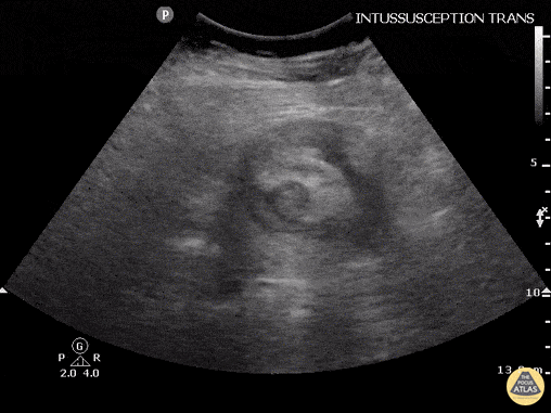 Bowel-GI - Intussusception Adult