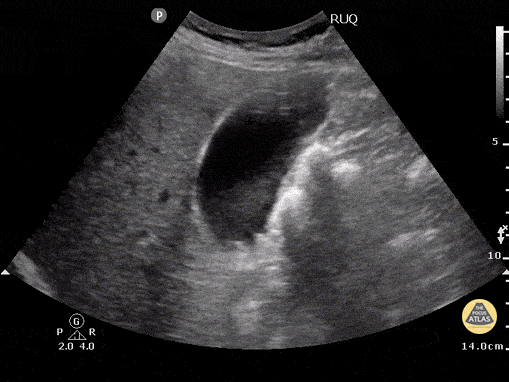Biliary - Cholelithiasis - Neck Stones